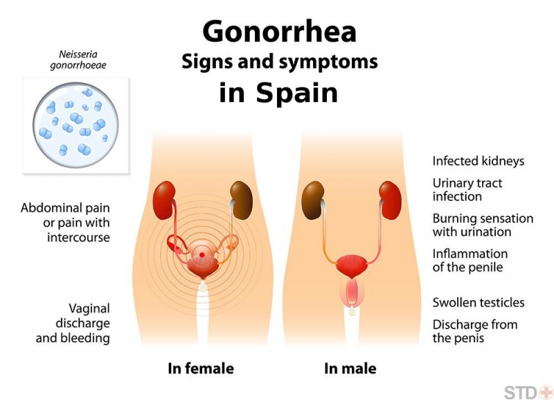 La super gonorrea española se da en hombes y mujeres de la peninsula iberica. No existe cura alguna.